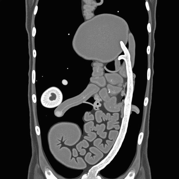 Medical Scan Showing Ducts