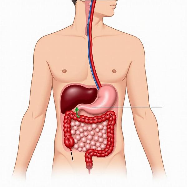 Diagram of a Peptic Ulcer